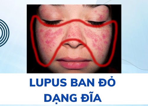 Hiểu rõ bệnh lupus ban đỏ dạng đĩa giúp ngăn ngừa biến chứng của bệnh